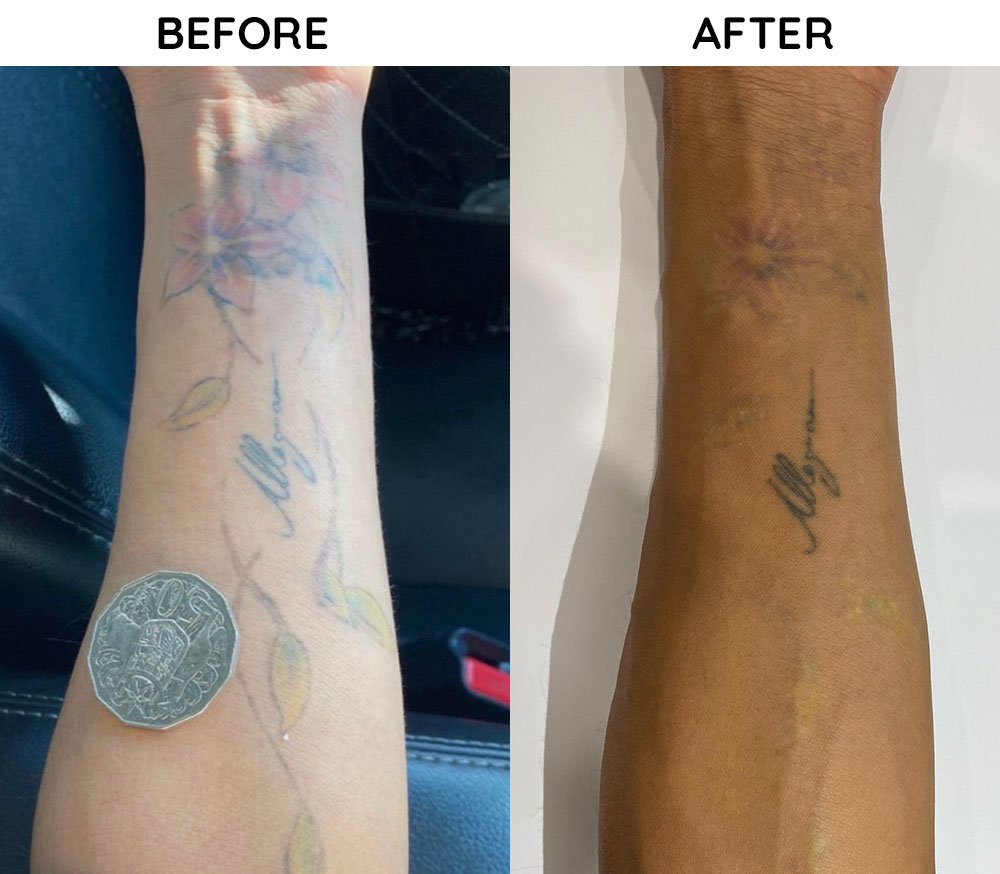 Magill Laser Tattoo Removal - SMP Lasers